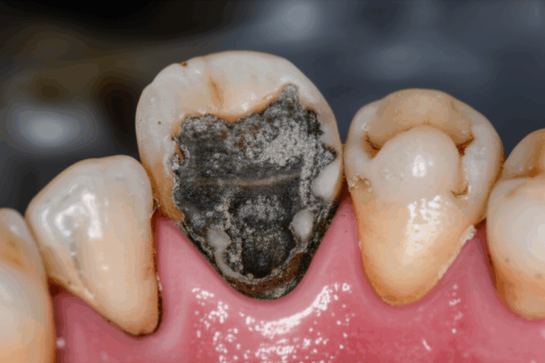 Can Mold Cause Dental Problems Unraveling the Oral Health Connection