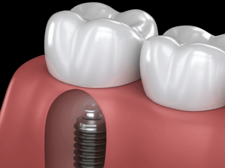 Dental Implant Failure Rates What Are the Chances and How to Prevent It