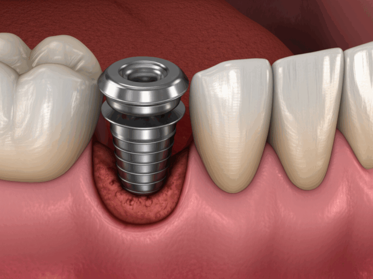 How Dental Implants Fail A Simple Guide to Causes Symptoms and Prevention