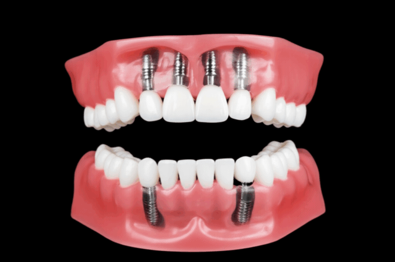 How Many Arches in Dental Implants Understanding Full Mouth and Arch Specific Solutions