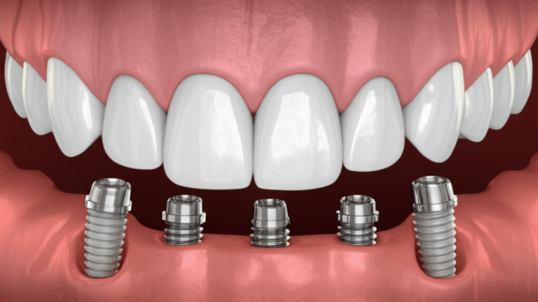 How Many Dental Implants Can You Have My Honest In Depth Guide