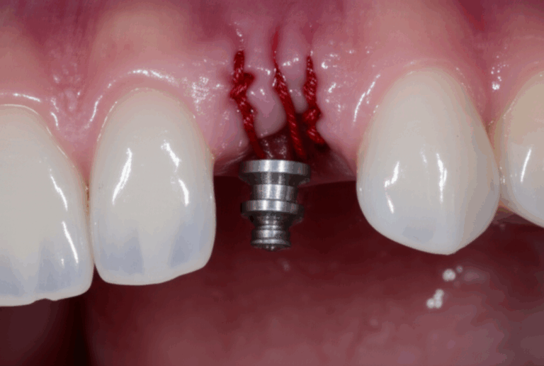 How Many Stitches After a Dental Implant Understanding What to Expect and Post Op Care