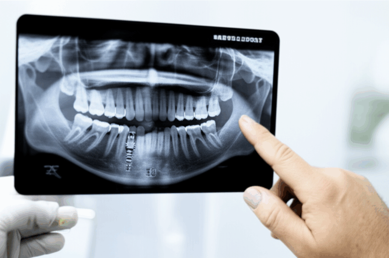 How Many Visits for a Dental Implant My Complete Guide to the Process