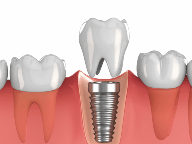 How Strong Are Dental Implants Understanding Their Durability Lifespan and Chewing Power