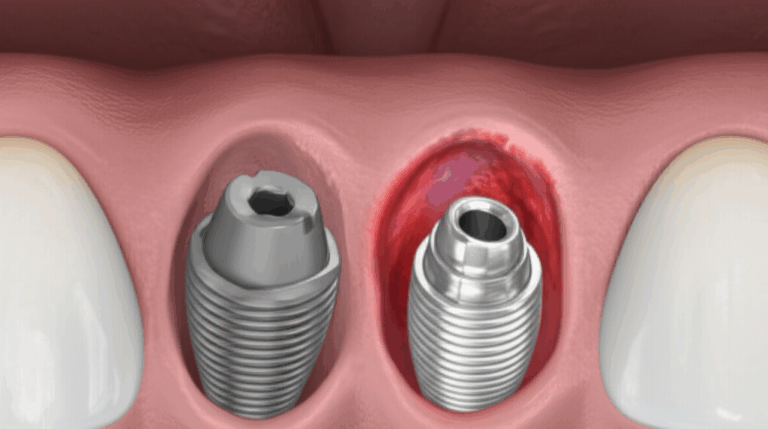How to Know if Your Dental Implant is Failing A Simple Guide