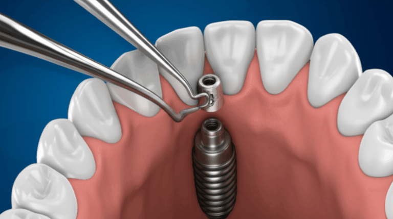 How to Remove Dental Implants My Comprehensive Guide to Implant Explantation