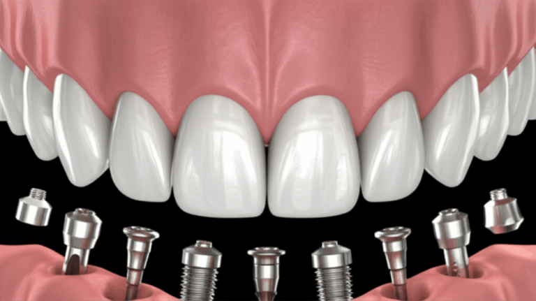 What Are All on X Dental Implants Your Complete Guide to Permanent Full Arch Teeth