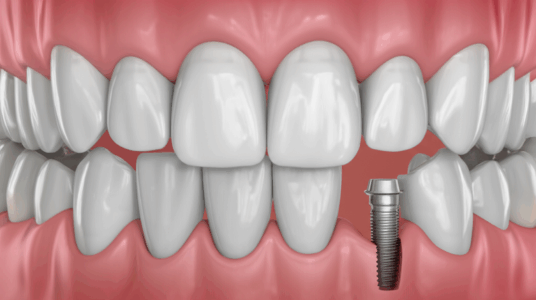 What Are Dental Implants For Understanding Their Purpose Benefits and Uses