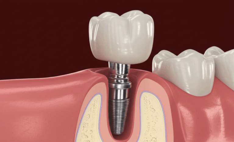 What Are Dental Implants Your Complete Compassionate Guide to Permanent Tooth Replacement