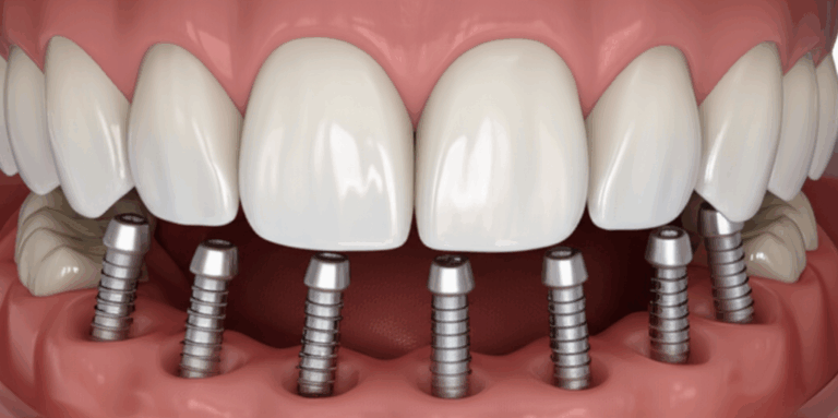 What Are Full Mouth Dental Implants Your Complete Guide to a Restored Smile