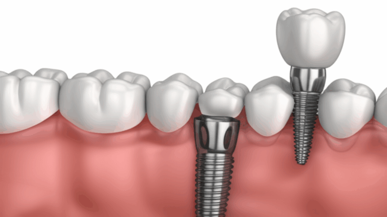 What Are the Risks of Dental Implants A Simple Guide for Everyone