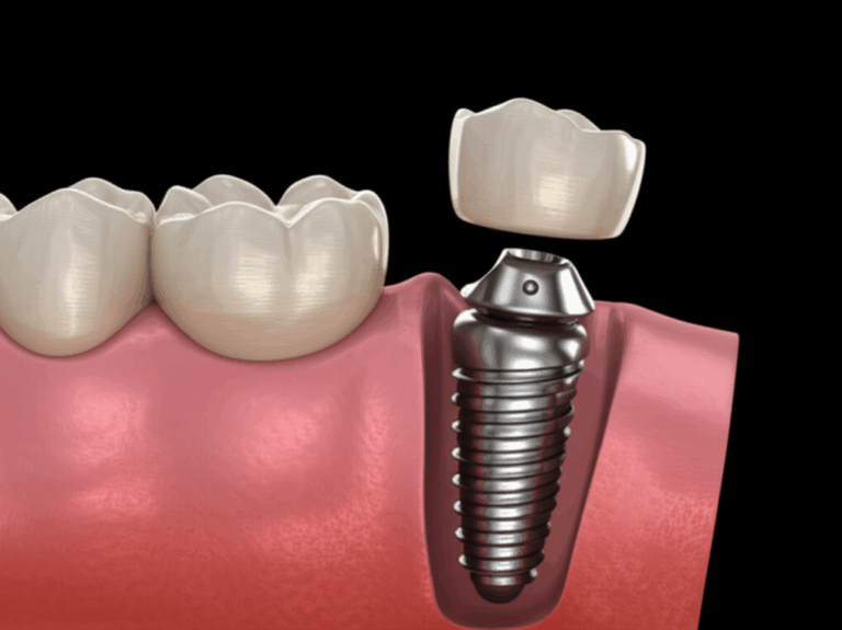 What Causes Dental Implant Failure Understanding Risks Prevention Solutions