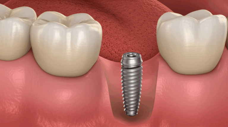 What is a Partial Dental Implant My Complete Guide to Single Tooth Replacement