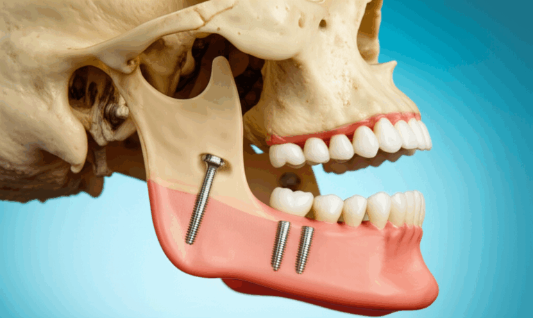 Zygomatic Dental Implants My Personal Journey to Understanding and Hope for Severe Bone Loss